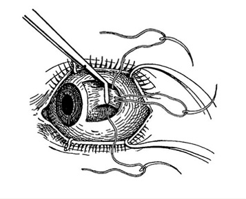 Capsula Lenticularis Capsula Lenticularis